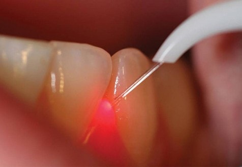 Laser Odontoiatria